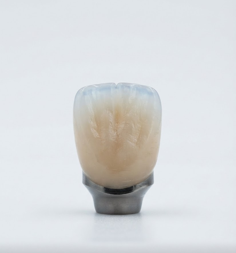 Metal-Ceramic Implant Prosthesis