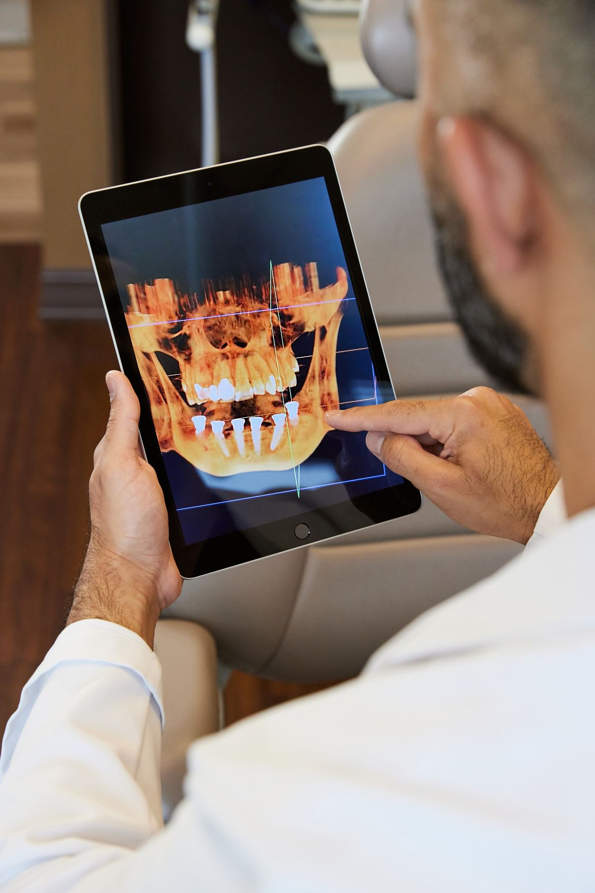 IOS Scanning for Implant Prosthesis